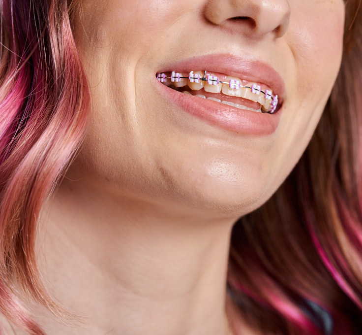 What are LightForce™ 3D Braces?