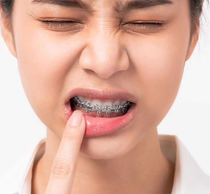 Discomfort after
a braces adjustment