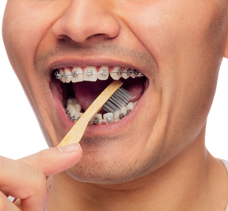 Food caught
in braces