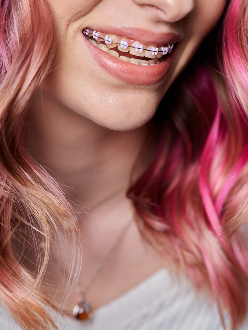 LightForce™ 3D braces