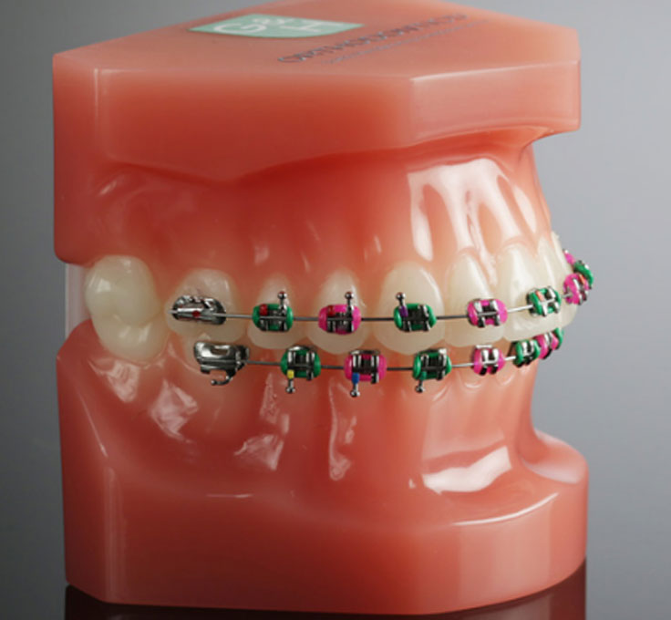 Loose or
broken brackets