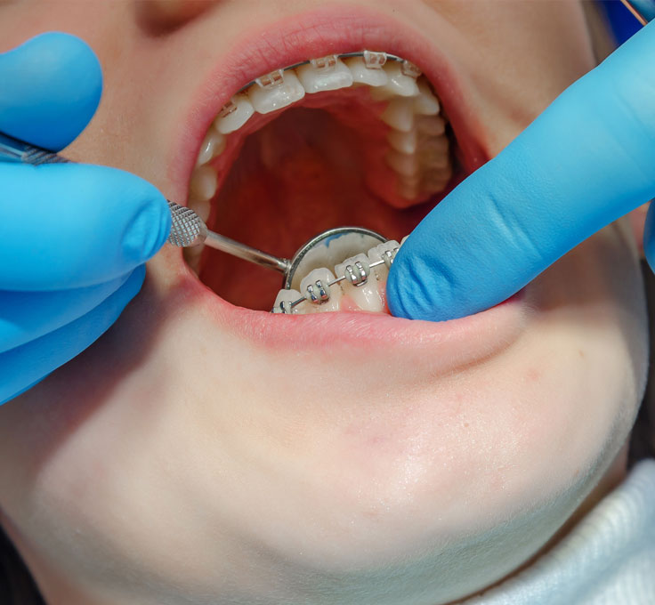 Mouth ulcers
or sore spots