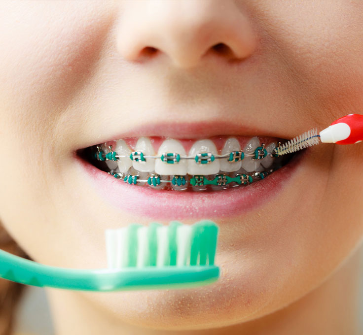 Brushing with braces