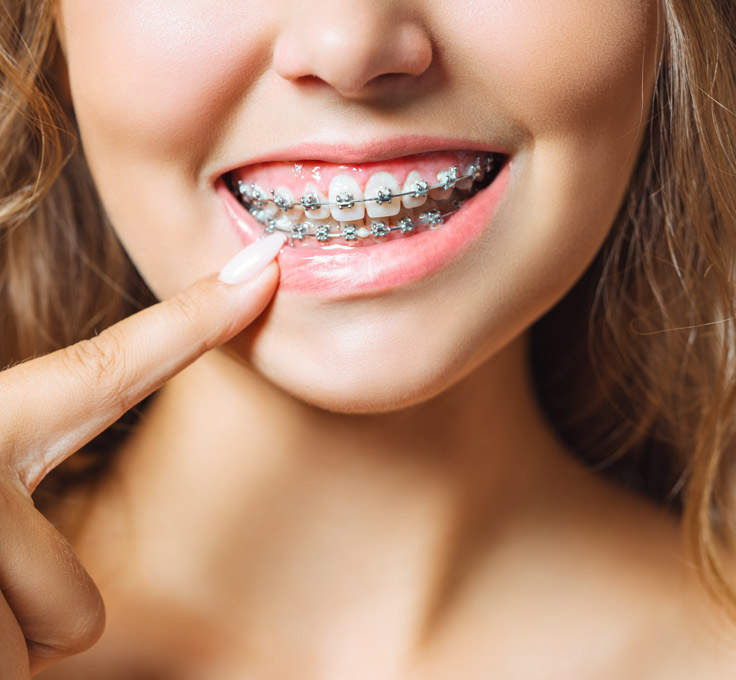 What are metal braces?
