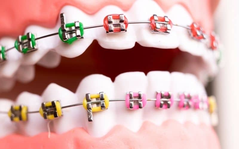 5 Myths of Braces, BUSTED!
