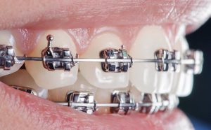 Why People Get Orthodontics On Their 6 Front Teeth